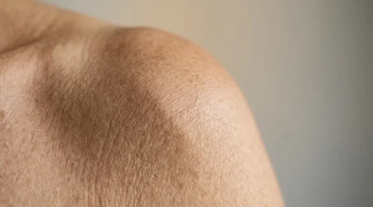 Close-up of an aging shoulder joint showing natural structural changes in connective tissue without text or diagrams